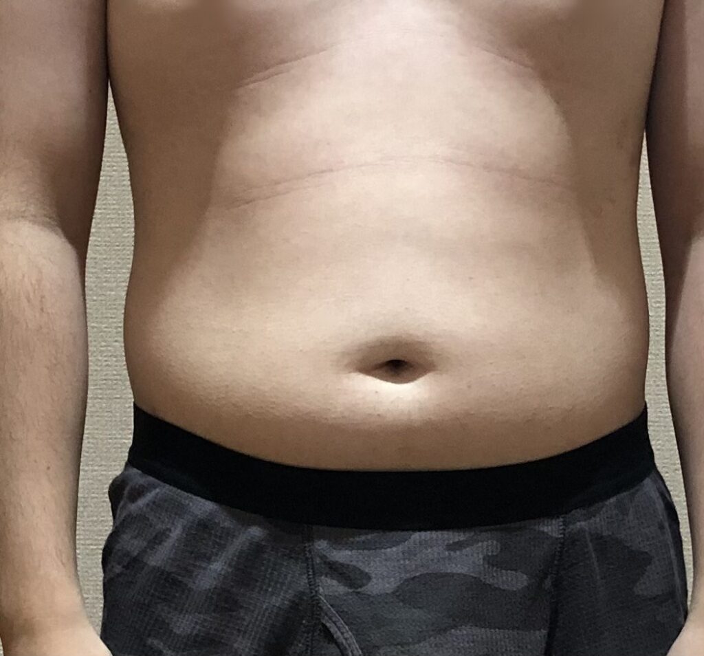 約5ヶ月後のお腹の写真